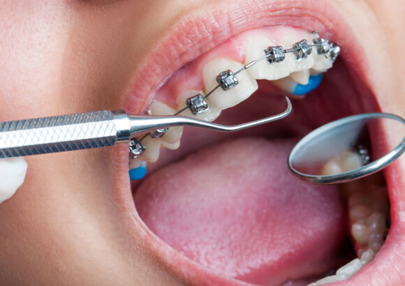 Diş Teli Tedavisi